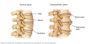 ans7_osteoarthritis- back pain bones