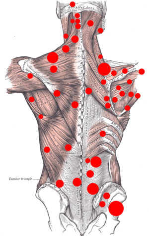 Myofascial Muscle Pain