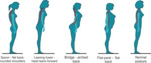 posture correction problems